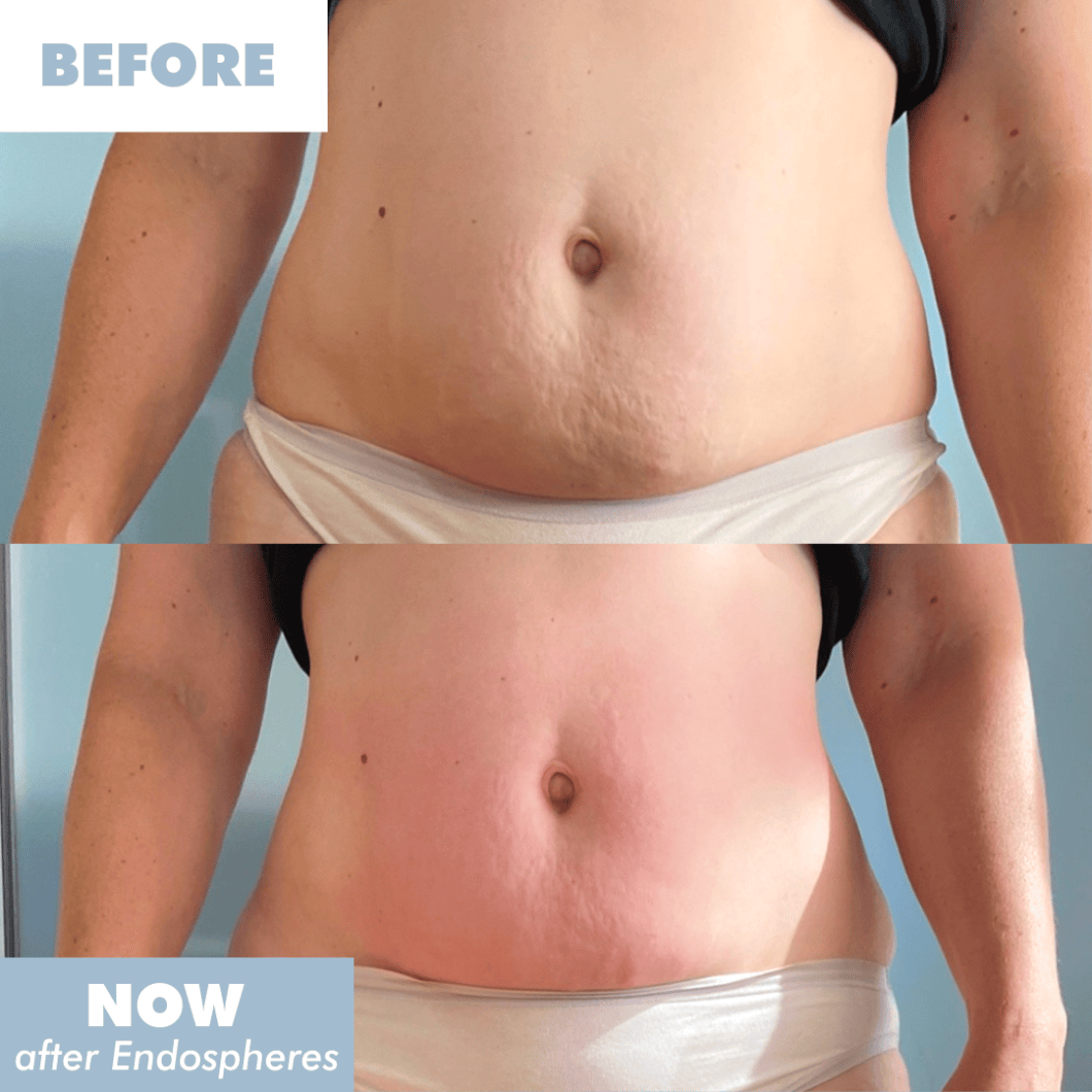 Original before and after Endosphères comparison
