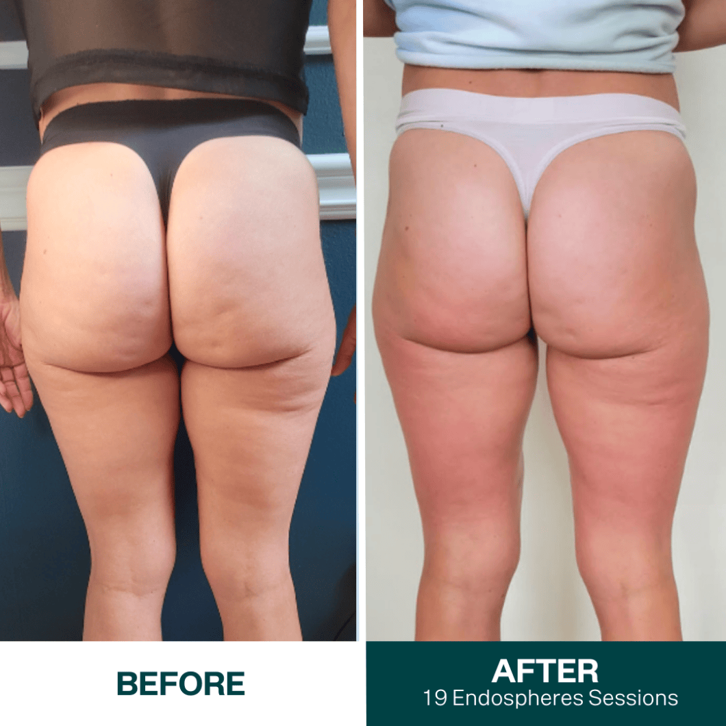 Original before and after Endosphères comparison