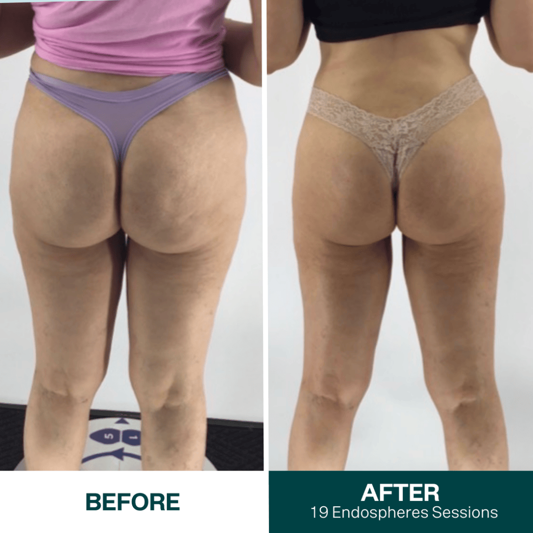 Original before and after Endosphères comparison